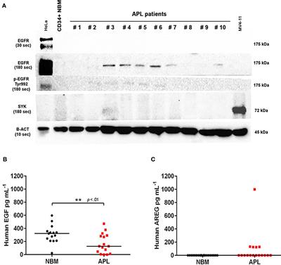 The Combination of Gefitinib With ATRA and ATO Induces Myeloid Differentiation in Acute Promyelocytic Leukemia Resistant Cells